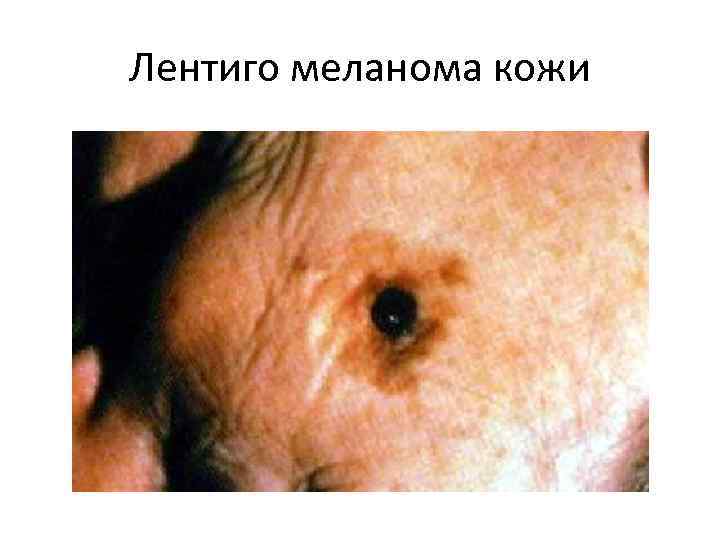 Лентиго меланома кожи 