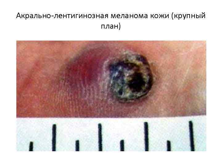 Акрально-лентигинозная меланома кожи (крупный план) 