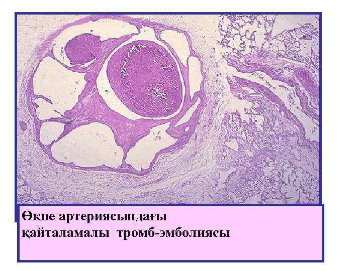 Өкпе артериясындағы қайталамалы тромб-эмболиясы 