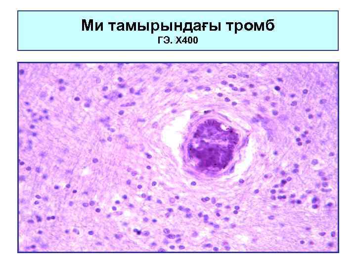 Ми тамырындағы тромб ГЭ. Х 400 