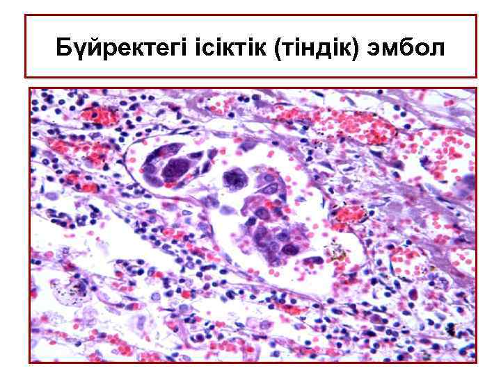 Бүйректегі ісіктік (тіндік) эмбол 