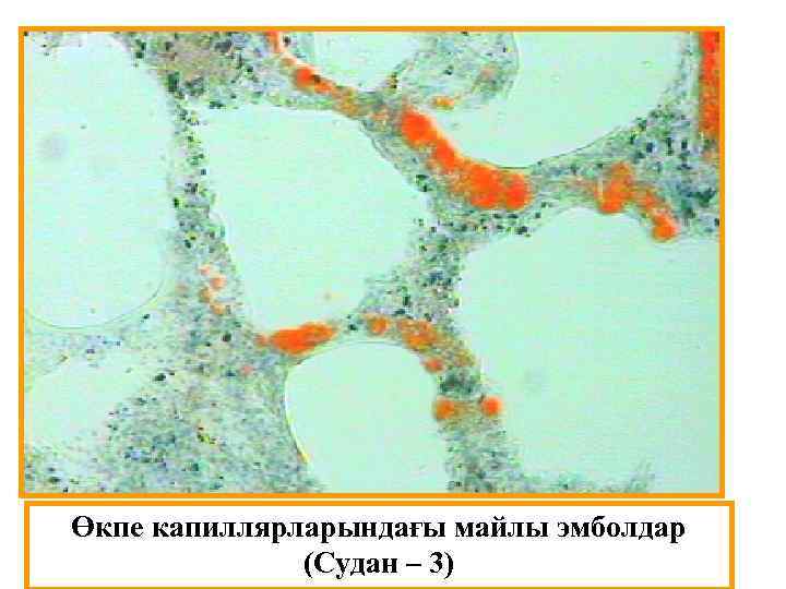 Өкпе капиллярларындағы майлы эмболдар (Судан – 3) 