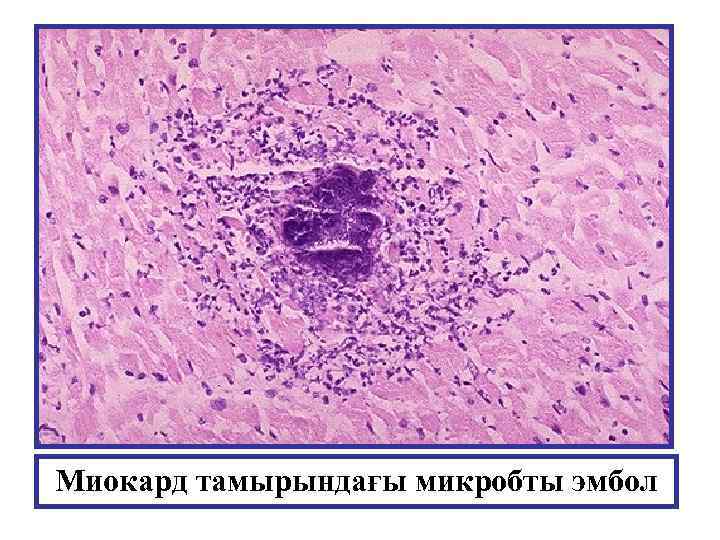 Миокард тамырындағы микробты эмбол 