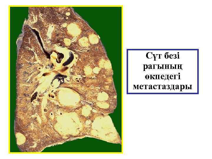 Сүт безі рагының өкпедегі метастаздары 