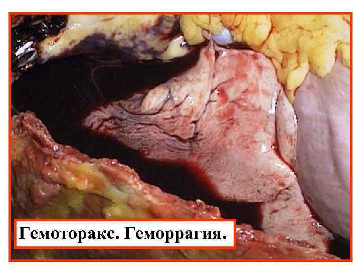 Гемоторакс. Геморрагия. 