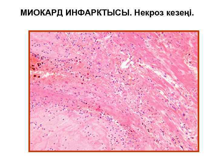 МИОКАРД ИНФАРКТЫСЫ. Некроз кезеңі. 