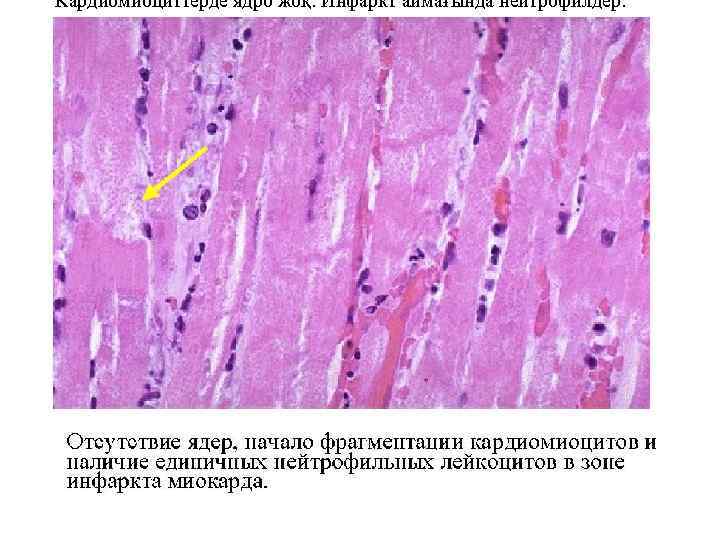 Кардиомиоциттерде ядро жоқ. Инфаркт аймағында нейтрофилдер. 