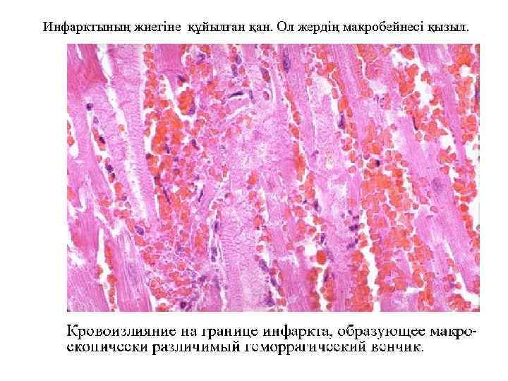 Инфарктының жиегіне құйылған қан. Ол жердің макробейнесі қызыл. 