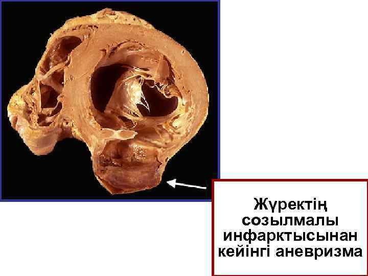 Жүректің созылмалы инфарктысынан кейінгі аневризма 