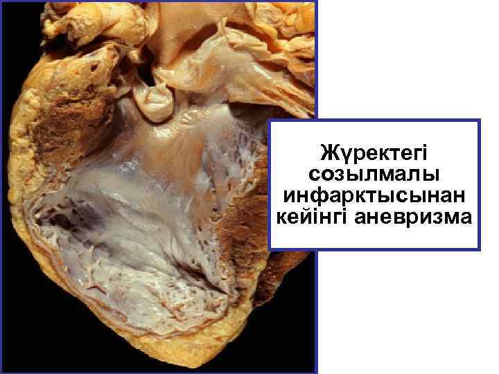 Жүректегі созылмалы инфарктысынан кейінгі аневризма 