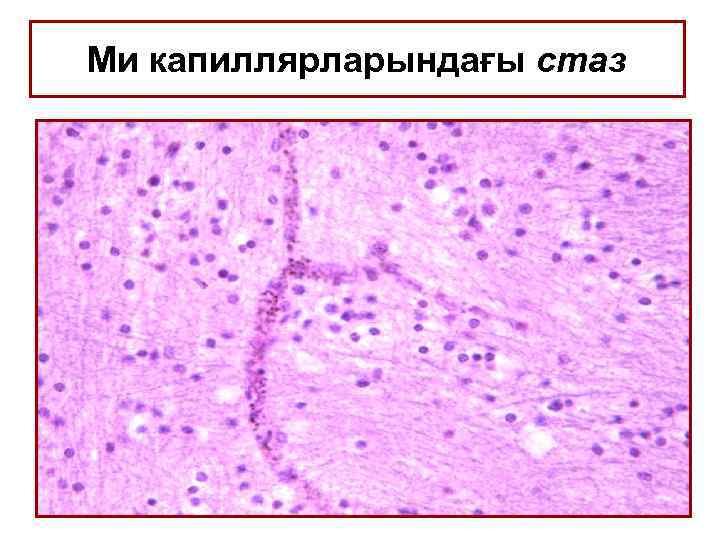 Ми капиллярларындағы стаз 