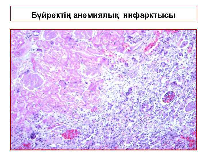 Бүйректің анемиялық инфарктысы 