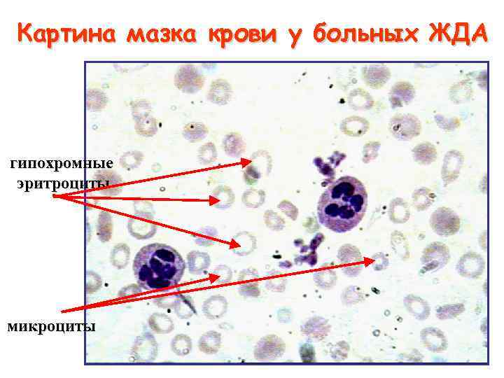 Картина мазка крови у больных ЖДА гипохромные эритроциты микроциты 