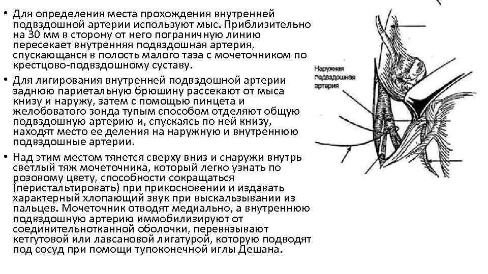  • Для определения места прохождения внутренней подвздошной артерии используют мыс. Приблизительно на 30