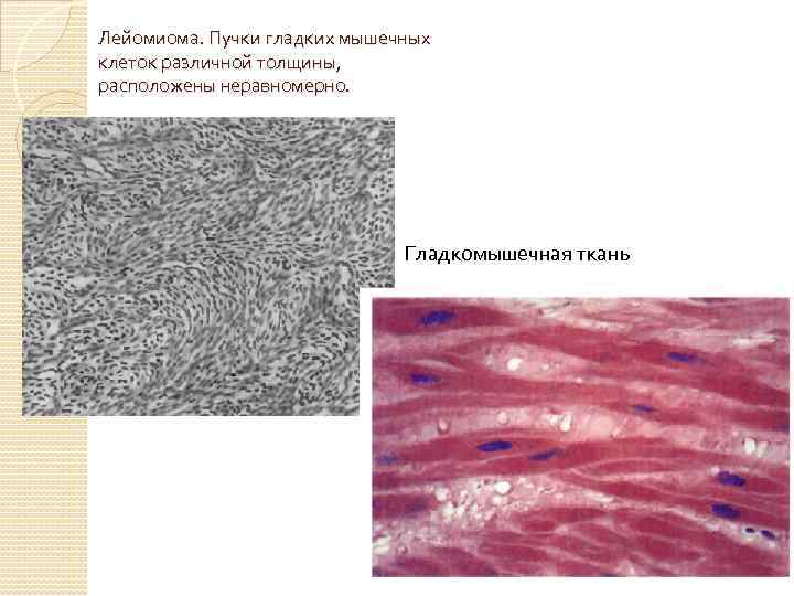 Лейомиома. Пучки гладких мышечных клеток различной толщины, расположены неравномерно. Гладкомышечная ткань 