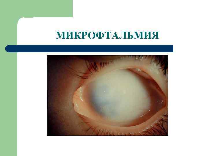 МИКРОФТАЛЬМИЯ 