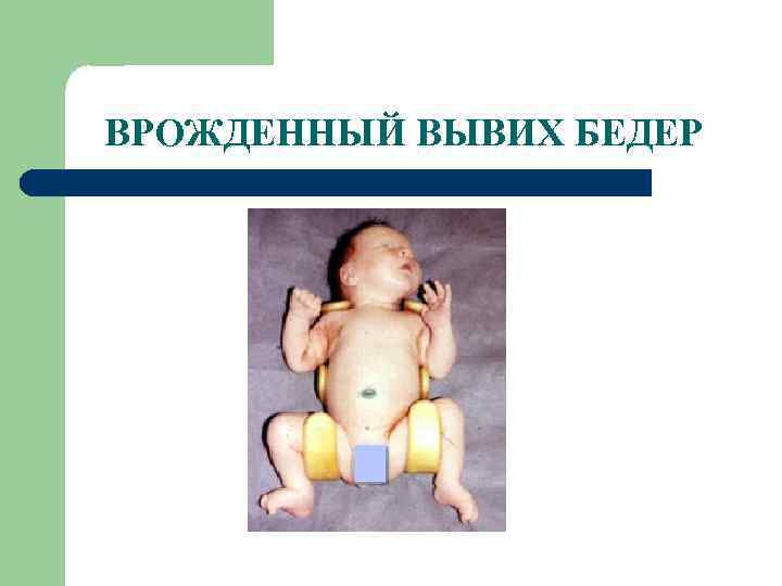 ВРОЖДЕННЫЙ ВЫВИХ БЕДЕР 