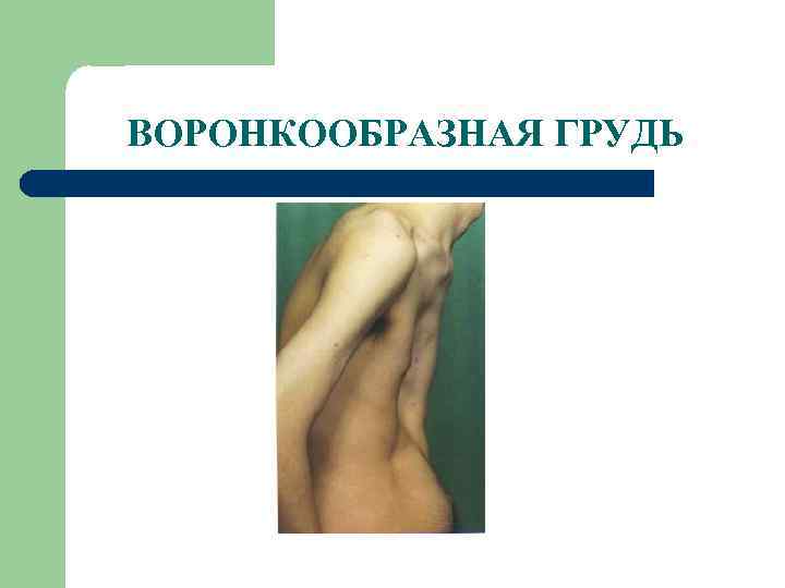 ВОРОНКООБРАЗНАЯ ГРУДЬ 