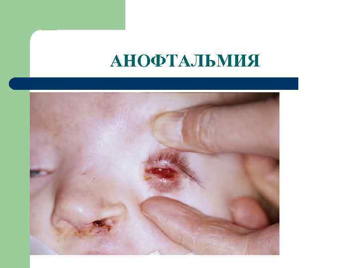 АНОФТАЛЬМИЯ 