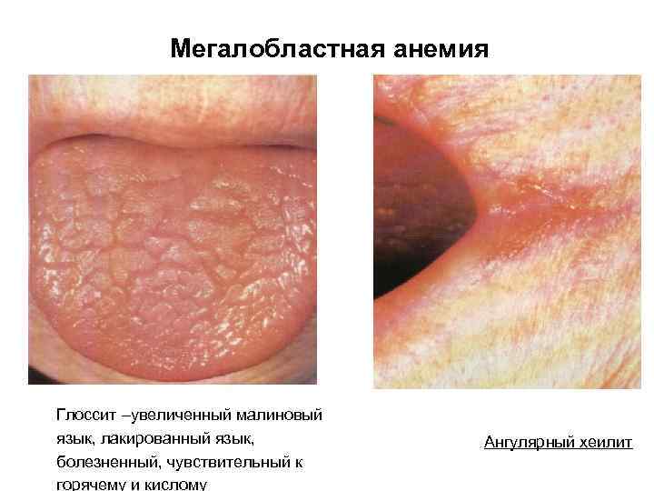 Мегалобластная анемия Глоссит –увеличенный малиновый язык, лакированный язык, болезненный, чувствительный к горячему и кислому