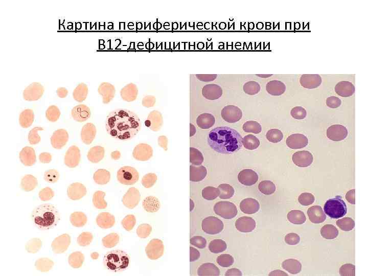 Картина периферической крови при В 12 -дефицитной анемии 