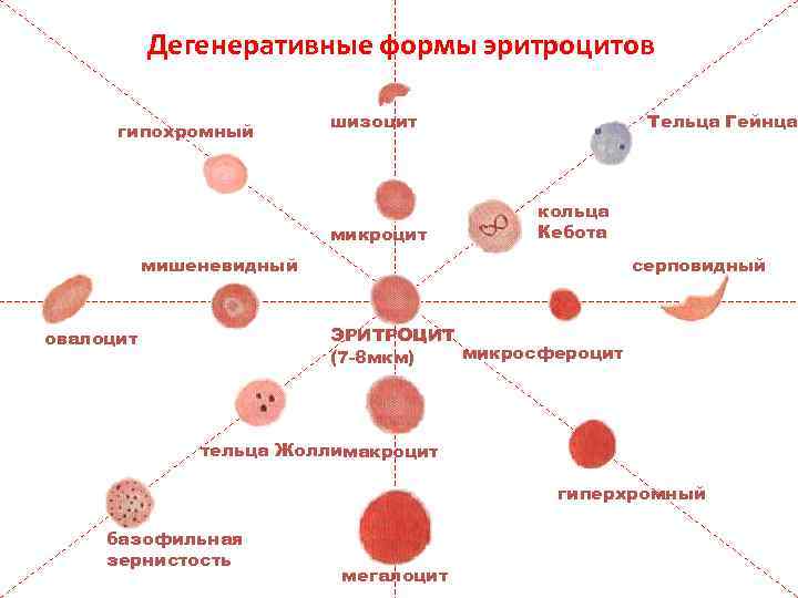 Дегенеративные формы эритроцитов гипохромный Тельца Гейнца шизоцит микроцит кольца Кебота мишеневидный серповидный ЭРИТРОЦИТ микросфероцит