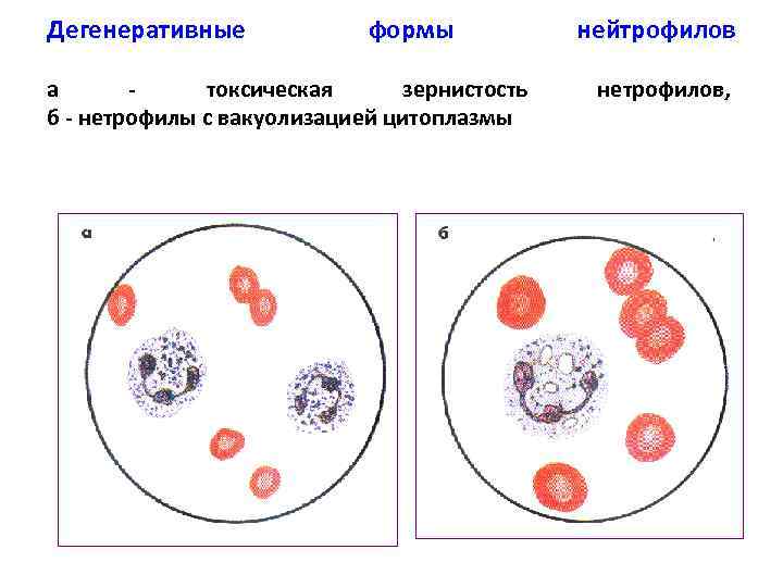 Дегенеративные формы а токсическая зернистость б - нетрофилы с вакуолизацией цитоплазмы нейтрофилов нетрофилов, 