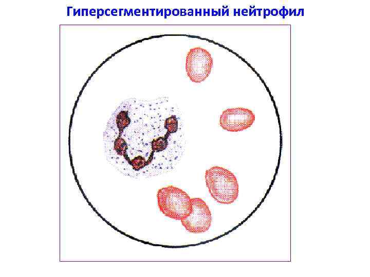 Гиперсегментированный нейтрофил 