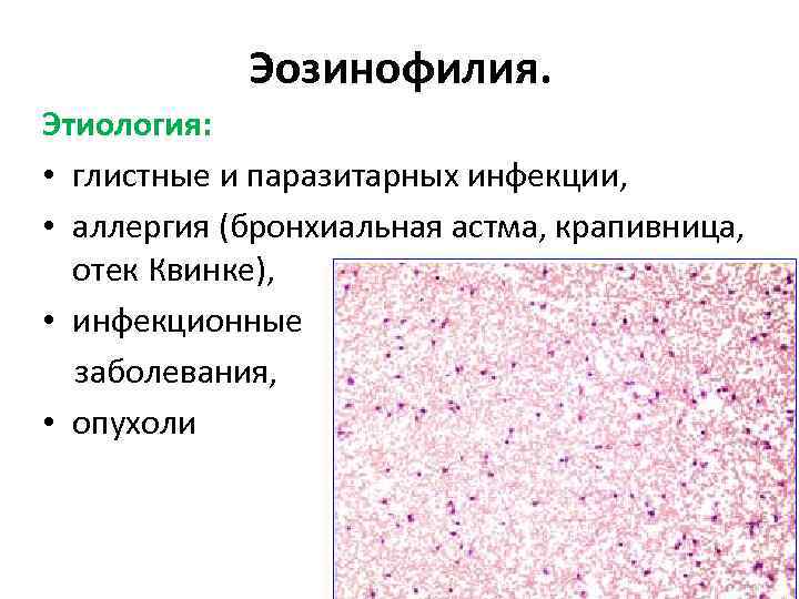 Эозинофилия. Этиология: • глистные и паразитарных инфекции, • аллергия (бронхиальная астма, крапивница, отек Квинке),