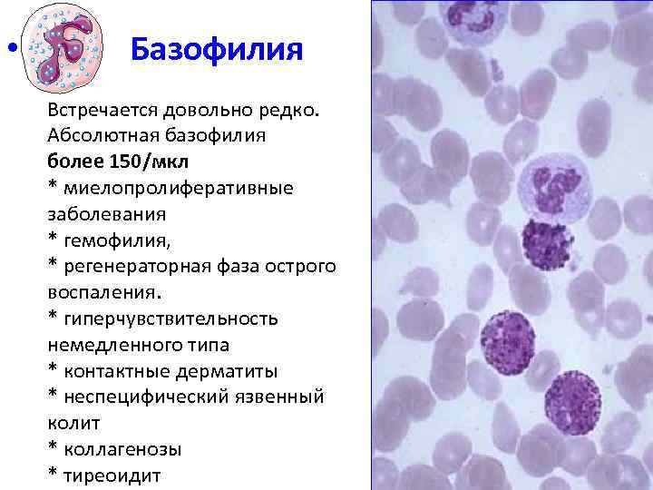  • Базофилия Встречается довольно редко. Абсолютная базофилия более 150/мкл * миелопролиферативные заболевания *