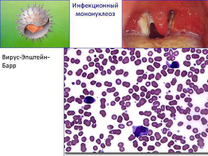 Инфекционный мононуклеоз Вирус-Эпштейн. Барр 