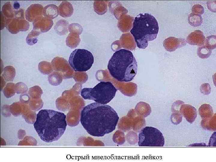 Острый миелобластный лейкоз 