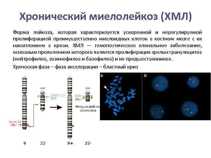 Хронический миелолейкоз (ХМЛ) Форма лейкоза, которая характеризуется ускоренной и нерегулируемой пролиферацией преимущественно миелоидных клеток