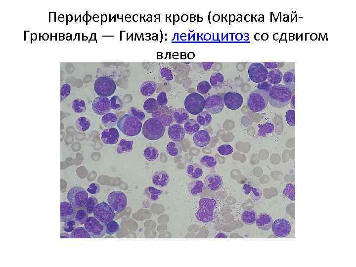 Периферическая кровь (окраска Май. Грюнвальд — Гимза): лейкоцитоз со сдвигом влево 