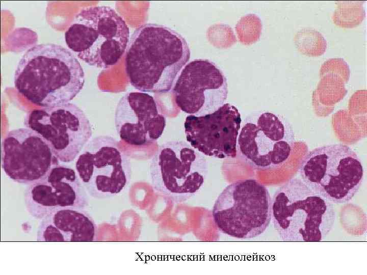 Хронический миелолейкоз 