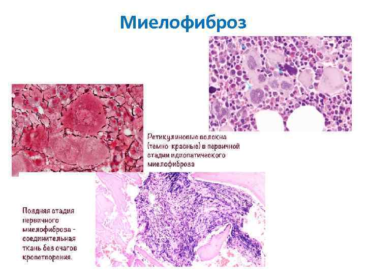 Миелофиброз 