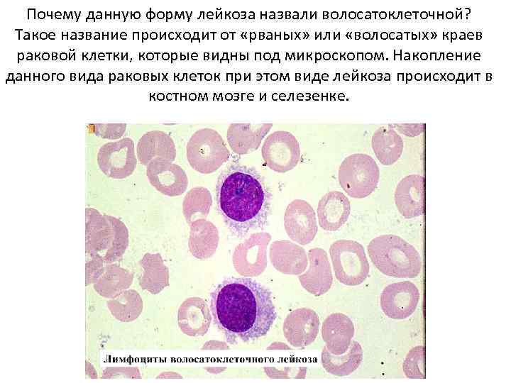 Почему данную форму лейкоза назвали волосатоклеточной? Такое название происходит от «рваных» или «волосатых» краев