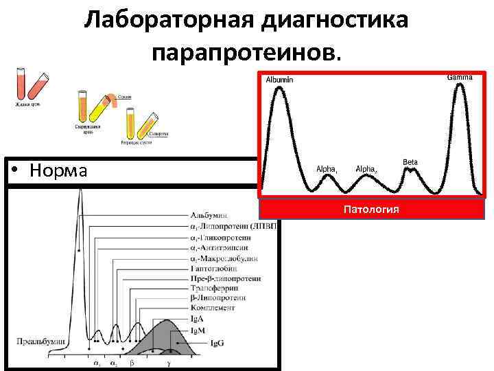 Лабораторная диагностика парапротеинов. • Норма Патология 