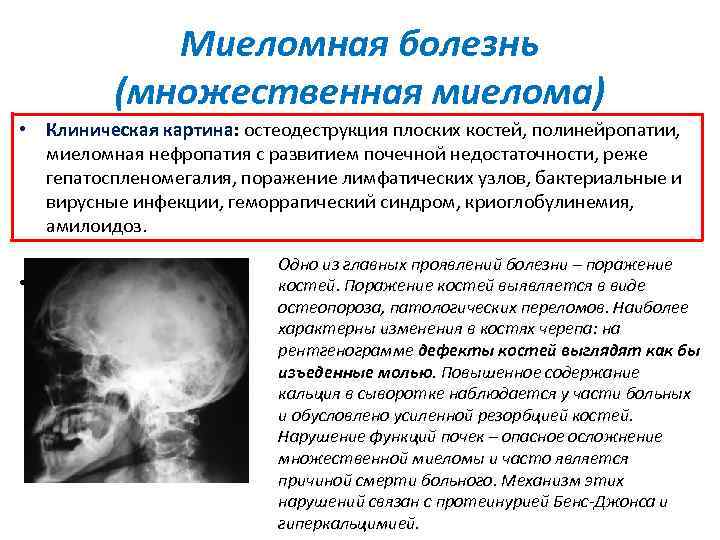 Миеломная болезнь (множественная миелома) • Клиническая картина: остеодеструкция плоских костей, полинейропатии, миеломная нефропатия с