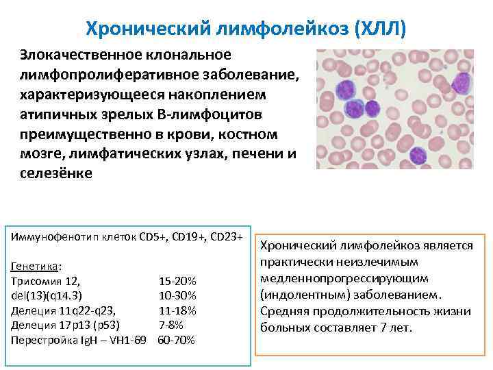 Хронический лимфолейкоз (ХЛЛ) Злокачественное клональное лимфопролиферативное заболевание, характеризующееся накоплением атипичных зрелых В-лимфоцитов преимущественно в