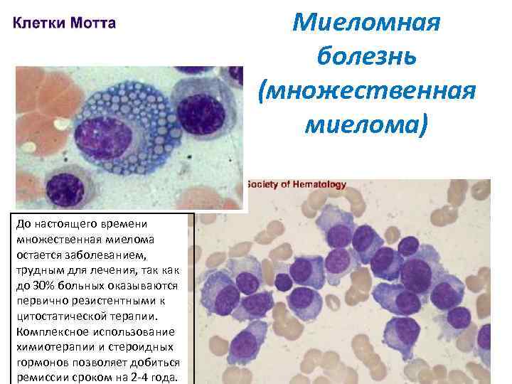 Миеломная болезнь (множественная миелома) До настоящего времени множественная миелома остается заболеванием, трудным для лечения,