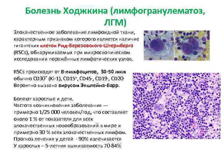Болезнь Ходжкина (лимфогранулематоз, ЛГМ) Злокачественное заболевание лимфоидной ткани, характерным признаком которого является наличие гигантских