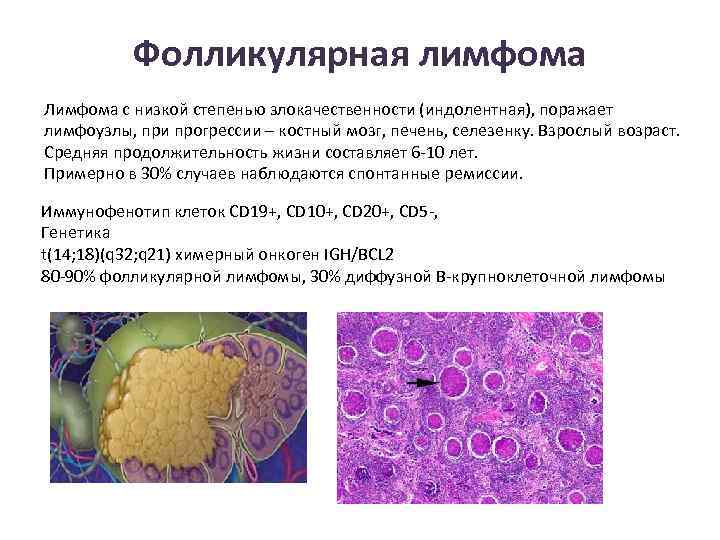 Фолликулярная лимфома Лимфома с низкой степенью злокачественности (индолентная), поражает лимфоузлы, при прогрессии – костный