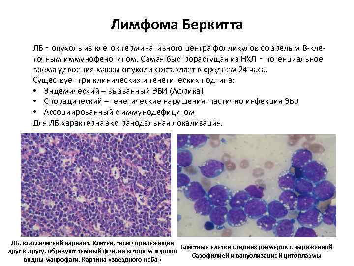 Лимфома Беркитта ЛБ ‑ опухоль из клеток герминативного центра фолликулов со зрелым В-клеточным иммунофенотипом.