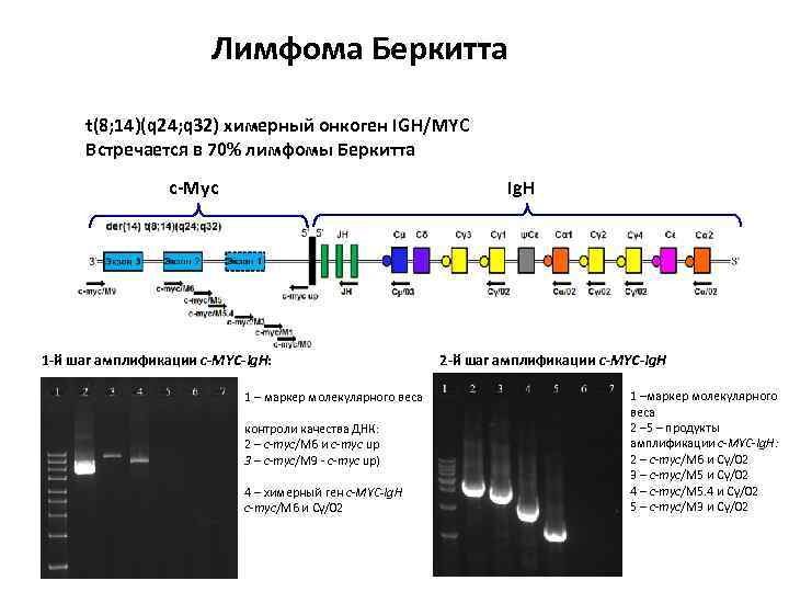 Лимфома Беркитта t(8; 14)(q 24; q 32) химерный онкоген IGH/MYC Встречается в 70% лимфомы