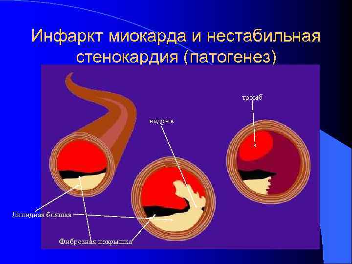 Инфаркт миокарда и нестабильная стенокардия (патогенез) тромб надрыв Липидная бляшка Фиброзная покрышка 