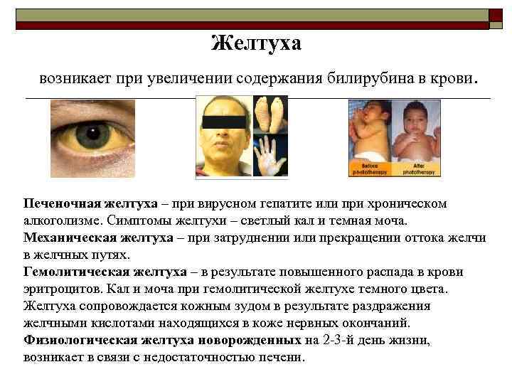 Желтуха возникает при увеличении содержания билирубина в крови. Печеночная желтуха – при вирусном гепатите