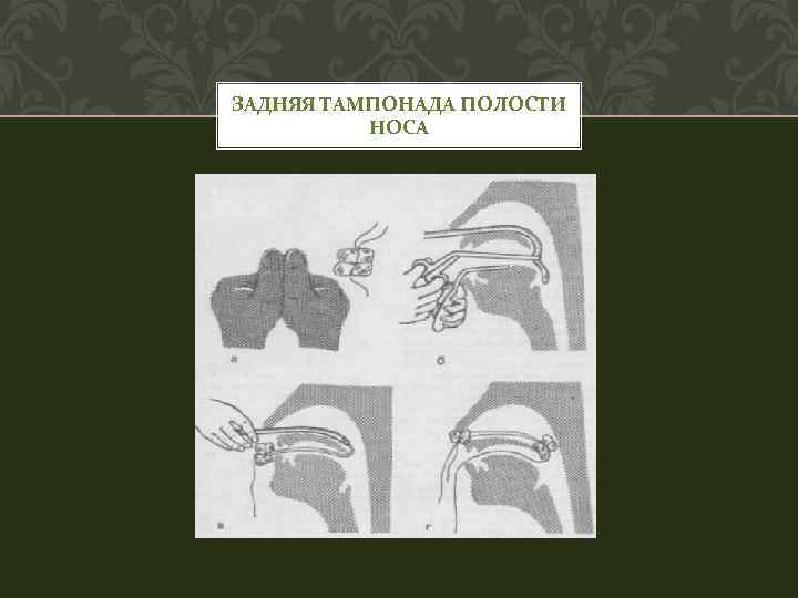 ЗАДНЯЯ ТАМПОНАДА ПОЛОСТИ НОСА 