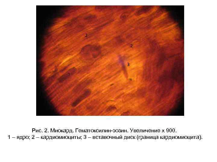 Рис. 2. Миокард. Гематоксилин-эозин. Увеличение х 900. 1 – ядро; 2 – кардиомиоциты; 3