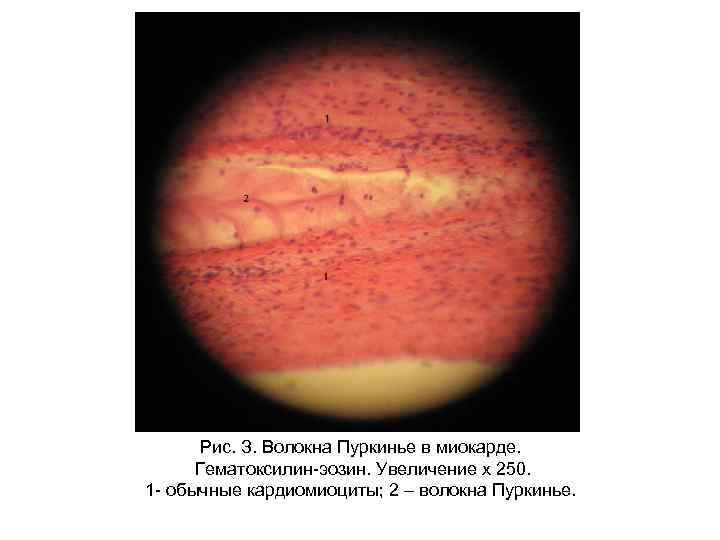 Рис. З. Волокна Пуркинье в миокарде. Гематоксилин-эозин. Увеличение х 250. 1 - обычные кардиомиоциты;